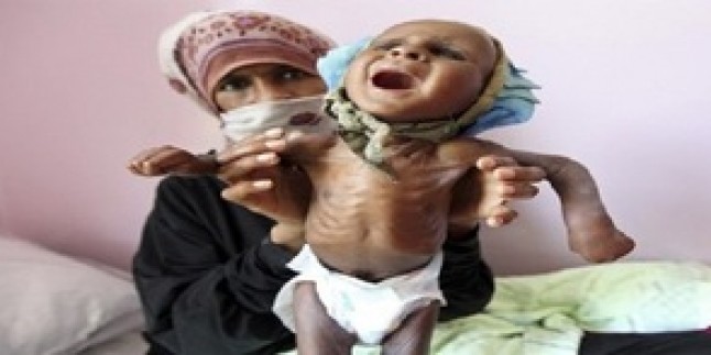 Yemen’de her 10 dakikada bir çocuk açlıktan ölüyor