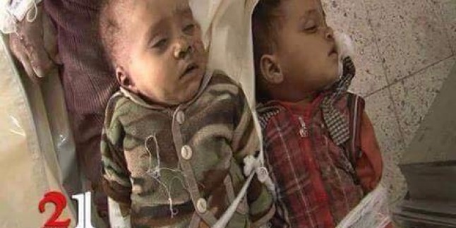 Foto: Suud Uçaklarının Sa’da Kentini Bombardımanında Şehid Olan 2 Bebek