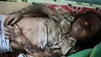 Suud Rejimi , Yemen Halkına Karşı Yasak Silahlardan Yararlanıyor