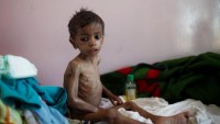 Yemenli Çocuklar 5 Yaşına Ulaşamadan Ölüyor
